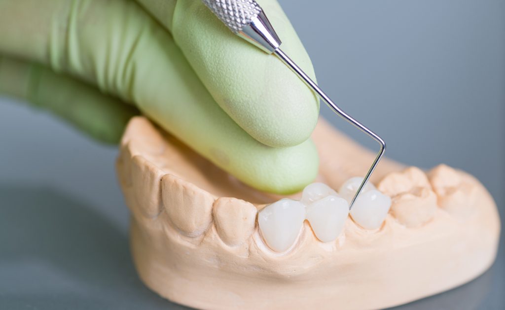 dental bridge Toronto dental implants